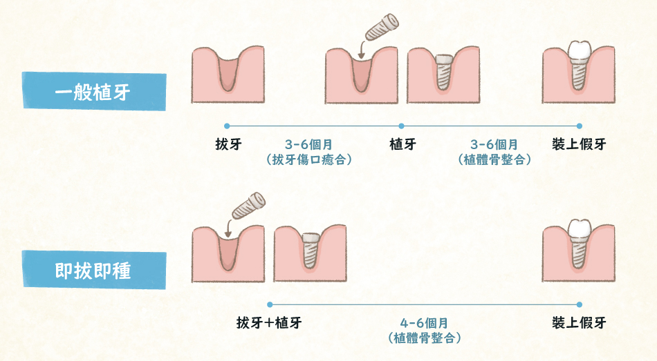 圖解“即拔即種”及“一般植牙”的差別？