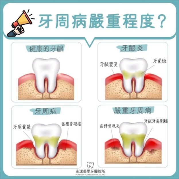 我的牙周病算嚴重嗎？